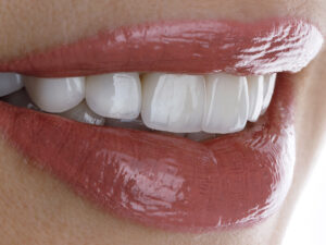 estética dental